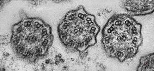 F,5y. | immotile cilia syndrome - nasal mucosa F,5y. | immotile cilia syndrome - nasal mucosa
